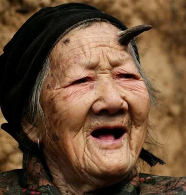 <p>Zhang Ruifang isimli, 100 yaşını geçtiği düşünülen kadın, alnının sol hizasında çıkan boynuzu yüzünden bundan 5 yıl önce tıp dünyasını hayrete düşürdü.</p>
<p> </p>