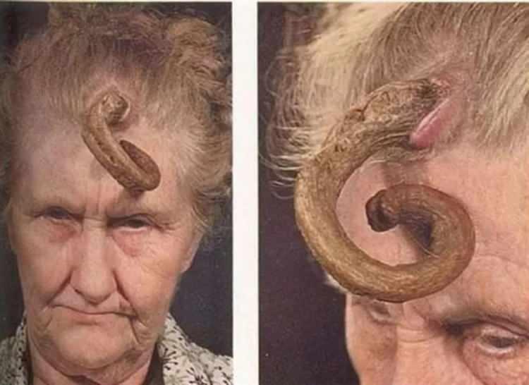 <p>Boynuz görüntüsündeki çıkıntıların sebebi 'cutaneous horns korn kutaneum2 (deride boynuz çıkıntısı) diye geçen hastalıktır. Boynuzların uzunluğu bir kaç milimetre ve bir kaç santimetreye kadar değişiklik gösterebilir. Korn kutaneum, daha çok yüz, kulaklar ve güneş gören diğer bölgelerde görülür.</p>
<p> </p>