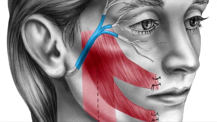 <p><strong>* Baş dönmesi deri de şiddetli döküntü ve ağız burun çevresinde yaralara neden olur.</strong></p>
<p> </p>
<p><strong>RAMSAY HUNT SENDROMU TEDAVİSİ VAR MI?</strong></p>
<p> </p>
<p><strong>Virüsün enfeksiyona neden olmaması için ilaçlar verilir. Ayrıca belirtiler takip edildikten sonra yüzde felce benzer atakların yaşanmaması için ilaçlarda takviye edilir. </strong></p>