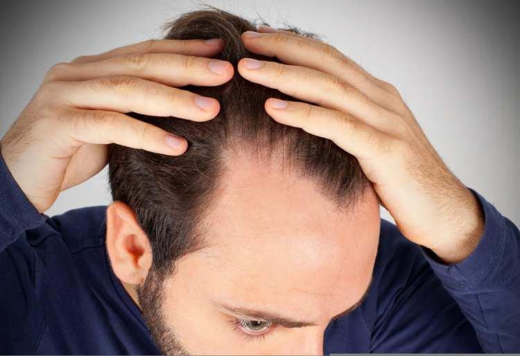<p>Populer Science'de yer alan habere göre, Alopecia areata, bağışıklık sisteminin saç köklerini yabancı işgalci zannedip bunlara saldırmasıyla meydana gelen otoimmün bir bozukluk. Kafanın etrafında dairesel açık bölgeler biçiminde başlayabilen saç kaybı, genişleyerek üst üste binen daha büyük bölgelere dönüşebiliyor.</p>
