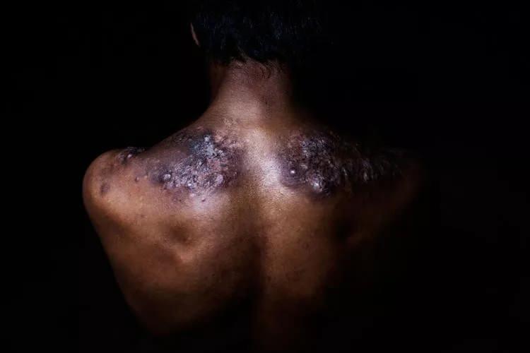 <p>Yaralı sırt, deforme olmuş belkemiği ve yamuk bacaklar madenciler arasında yaygın. Madencilerin çoğu, kükürdü yanardağın kraterinden merkez kampa taşıdıkları fiziksel açıdan yorucu çaba sırasında dinlenmeye ve yeniden güç kazanmaya pek zaman ayırmıyor.</p>

<p> </p>
