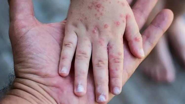 <p>Ghebreyesus, şu an çiçek aşılarından MVA-BN'nin Kanada, Avrupa Birliği ve ABD tarafından onaylandığı bilgisini paylaşarak, "LC16 ve ACAM2000 aşılarının da maymun çiçeğine karşı kullanımı üzerinde duruluyor." diye konuştu.</p>

<p> </p>
