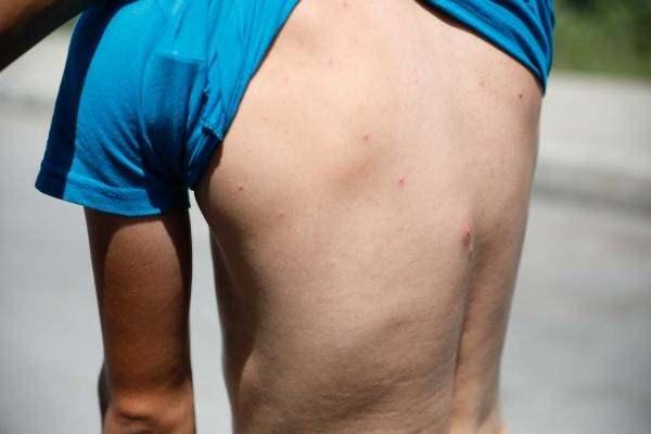 <p>Mahalle sakinleri, yakındaki dere nedeniyle artan sivrisineklerin soktuğu çocuklarda kaşınma sonrası yaralar oluştuğunu söyledi. Sivrisineklerin soktuğu çocukların bacakları ve kollarında oluşan yaraları gösteren mahalle sakinleri, durumun çözümü için yetkililere seslendi. </p>