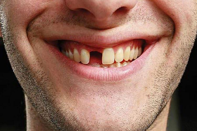 <p><strong>Diş, besinleri öğütmekten estetik görünüme kadar birçok alanda faaliyet göstermektedir. Birçok insan eksik dişler dış görünümü etkilemiyorsa, diş kaybını hafife alır. "Çektim bitti diye" düşündüren eksik dişlerin zararı ise bir hayli dikkat çekiyor. Peki, eksik dişlerin olması ağızda ne gibi zararlara yol açar?</strong></p>
