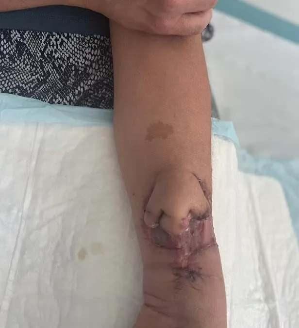 <p>Yıllardır hiçbir şeyin kokusunu alamayan Carine, yeni burnuyla yeniden koku aldığını fark edince büyük şaşkınlık yaşadı. Kadın daha iyi nefes alabildiğini ve bahçesindeki bitkilerin kokusunu aldığını söylerken, doktorlar koku duyusunun gelişmesi için yeni bir ameliyat düzenlemeye hazırlanıyor.</p>