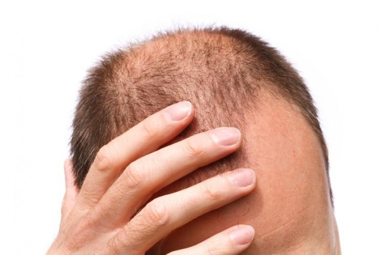<p><span style="color:#800000"><strong>Saç seyrelmesi en sık karşılaşılan deri hastalıklarından bir tanesidir. Doğru tedavi yöntemini uygulayabilmek için mutlaka bir doktora başvurulmalı ve saç dökülmesinin nedeni araştırılmalıdır. Gün içinde 50 ile 100 saç teli dökülmesi oldukça normaldir. </strong></span></p>
