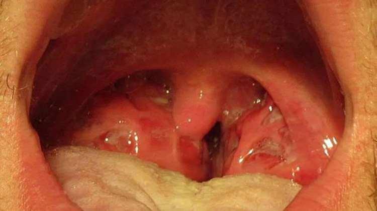 <div>STREP A  NASIL YAYILIR?</div>

<div> </div>

<div>UKHSA’da sağlık danışmanı olan Dr. Yimmy Chow, konuya ilişkin yaptığı açıklamada, "A Grubu streptokok enfeksiyonları genellikle hafif hastalıkla sonuçlanır. Bunlar boğaz ağrısı, ateş ve küçük cilt enfeksiyonlarını içerir ve tam bir antibiyotik kürü ile tedavi edilebilir. Nadir vakalarda ciddi bir hastalık yaşanabilir. Yüksek ateşi, şiddetli kas ağrıları, açıklanamayan kusma veya ishal görüldüğünde hemen tıbbi yardım alınmalıdır" ifadelerini kullandı. </div>

<div> </div>

<div> </div>

<div>Dr. Chow, ayrıca Strep A’nın öksürme, hapşırma ve ciltten cilde temas yoluyla yayılabileceğini belirterek, “65 yaşın üzerindeki kişiler, HIV'li olanlar, steroid ilaçları kullananlar veya diyabet, kalp hastalığı veya kanserden muzdarip olanların, Strep A’ya yakalanma riski en yüksektir” diyerek en yoğun risk altındaki grubu açıkladı.</div>
