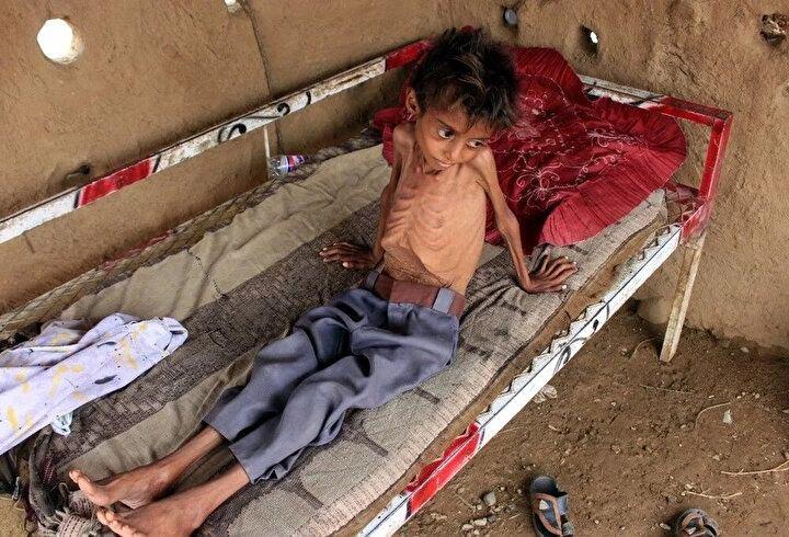 <p>Şiddetli akut yetersiz beslenmeden muzdarip on yaşında bir çocuk olan Hassan Razem, 25 Temmuz 2022'de Yemen'in kuzeybatısındaki Hajjah eyaletinin Abs bölgesinde görülüyor. Hükümet yanlısı güçler ile Husi isyancılar arasında yedi yıldır süren bir iç savaş, ülkeyi kıtlığın eşiğine getirdi. Birleşmiş Milletler'in dünyanın en kötü insani krizi olarak adlandırdığı olayda yüz binlerce kişinin öldüğü ve milyonlarca kişinin yerinden edildiği tahmin ediliyor.<br />
</p>