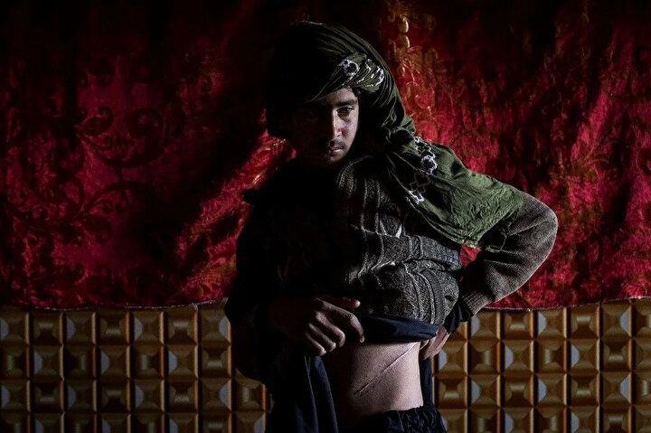 <p>4 Şubat 2022'de çekilen bu fotoğrafta, ailesini açlıktan kurtarmak için daha önce böbreğini satan Afgan bir adam, Herat ilinin İncil ilçesine bağlı Sayşanba Çarşısı'ndaki evinin içindeki ameliyat izlerini gösteriyor. İşsiz, borca batmış ve çocuklarını beslemek için mücadele eden Nooruddin, ailelerini kurtarmak için bir organını feda etmeye istekli sayısı giderek artan Afganlardan biri olan böbreği satmaktan başka çaresi olmadığını hissetti.<br />
 </p>
