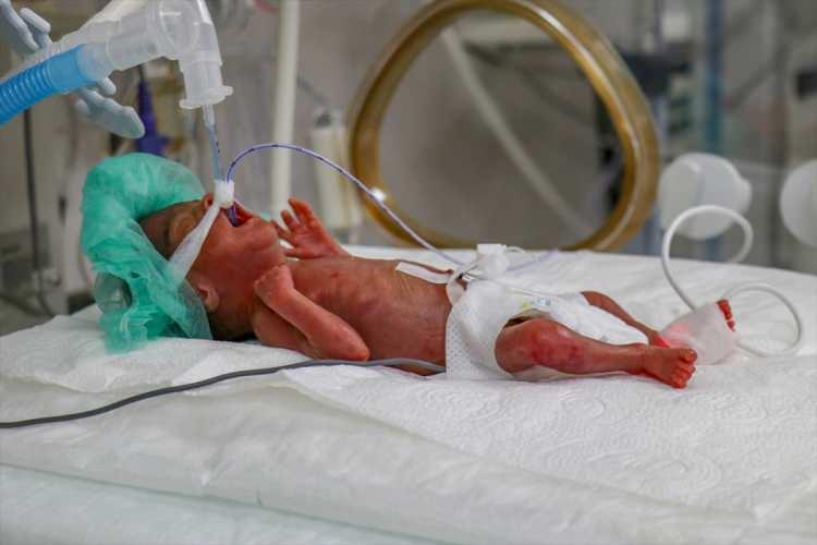 <p>Organları gelişmeyen ve solunum yetmezliği yaşayan "parmak bebek"i kuvöze alan sağlık çalışanları, beslenmesinden bakımına tüm ihtiyaçlarıyla yakından ilgileniyor.</p>
