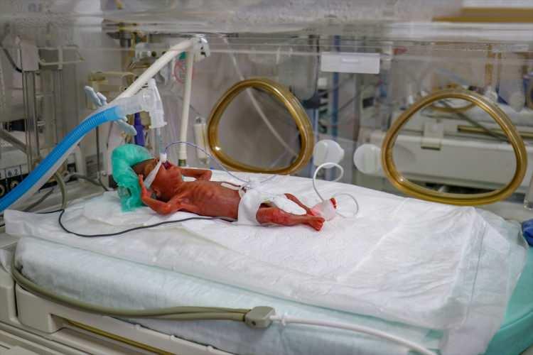 <p>Van'da Yüzüyncü Yıl Üniversitesi Dursun Odabaş Tıp Merkezi Yenidoğan Yoğun Bakım Ünitesi'nde doğumuna daha aylar olan 400 gram ağırlığında bir parmak bebek dünyaya geldi.</p>
