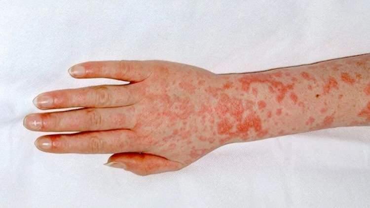 <p>İnvaziv streptokok enfeksiyonları ya da nekrotizan fasiit gibi hastalıklara yol açabilen Strep A, Türkçeye kızıl olarak geçen ya da İngizcede “scarlet fever” diye bilinen hastalığın da etkeni.</p>
