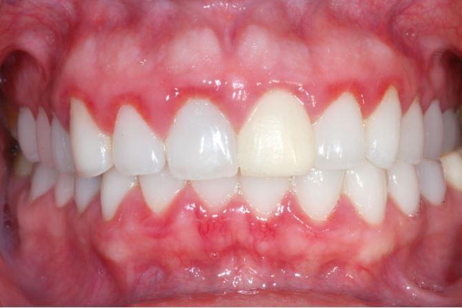 <p><span style="color:#800080"><strong>Diş etlerinin kırmızı görüntüde olmaları, kalp krizi riskinin bir belirtisi olan "periodontitis hastası" yani diş eti hastalığı olabileceğinizin bir belirtisidir.</strong></span></p>
