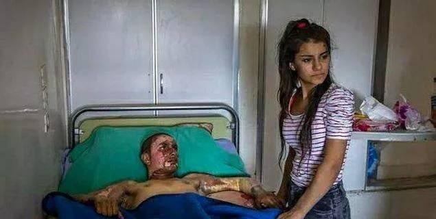 <p>Suriye'deki savaşta yüzü yanan bir çocuk ve korkusundan sevgilisinin yüzüne bakama</p>