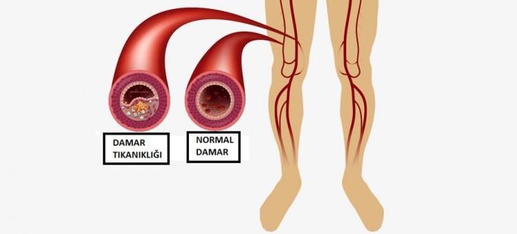 <p><span style="color:#2F4F4F"><strong>Damar tıkanıklığı, bir kan damarının genellikle damar sertliği ya da bir pıhtı nedeniyle tıkanmasıdır. Tıkanıklığa neden olan pıhtı, sıklıkla damarlarda aterosklerotik plaklar nedeniyle daralmış bölgelerde gelişir. </strong></span></p>