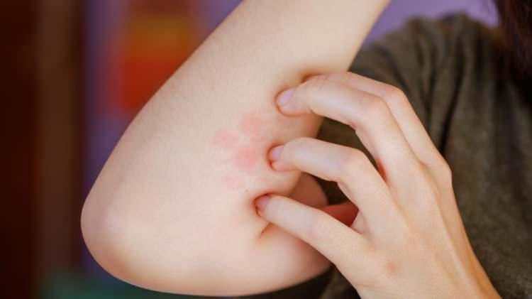 <p>Medipol Pendik Üniversite Hastanesi Enfeksiyon Hastalıkları ve Klinik Mikrobiyoloji Bölümü'nden Dr. Öğr. Üyesi Bengisu Ay, sivrisineğin 5’te 1’i büyüklüğünde olan tatarcık sineği ısırığının diğer sinek ısırıklarından farklı olmadığını ve yüzde 1’lik kesimin ısırıldığının farkında olduğunu söyledi. Tatarcık sineğinin enfeksiyon hastalığı etkenlerini taşıdığını aktaran Dr. Öğr. Üyesi Bengisu Ay, “Ülkemizde yaygın görülen tatarcık sineği, ‘Tatarcık Humması’ virüsü ile Layşmanyaz (Şark Çıbanı -Kala Azar) adı verilen bir hastalığın etkeni olan paraziti taşır” ifadelerini kullandı.</p>