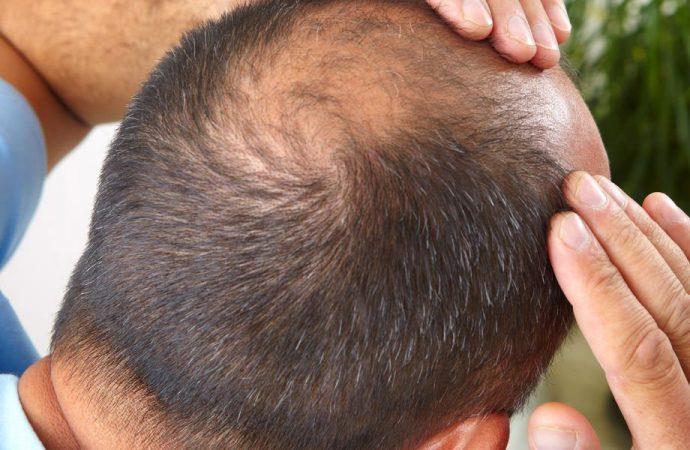 <p>Amerikan Saç Dökülmesi Derneği'ne (AHLA) göre, erkeklerde saç dökülmesinin yüzde 95'i erkek tipi kellik olarak da bilinen androgenetik alopesiden kaynaklanıyor.</p>

<p>Bu kalıtsal durum, Dihidrotestosteron (DHT) adı verilen testosterondaki bir yan ürüne karşı genetik bir duyarlılığa dayandırılıyor.</p>
