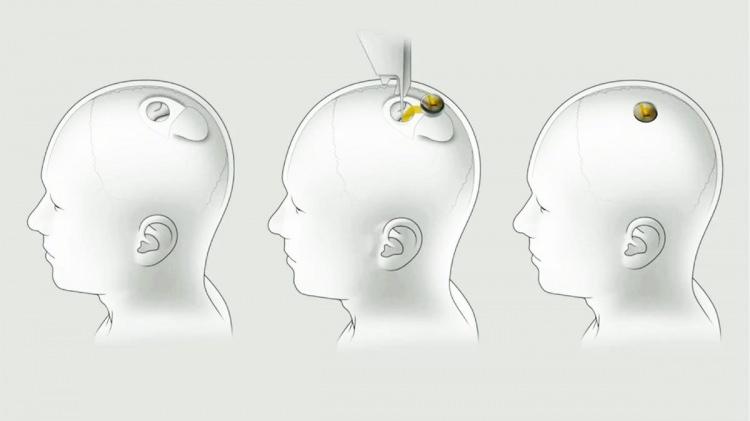 <p>Milyarder girişimci Elon Musk Cuma günü Fransa'da yaptığı açıklamada, beyin çipi girişimi Neuralink'in bu yıl ilk insan denemesine başlamasını beklediğini söyledi.</p>
