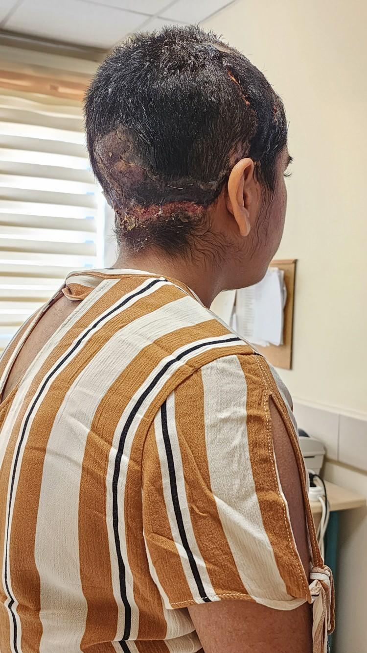 <p><span style="color:#A52A2A"><strong>'ASANSÖR İÇİN DE AYNI DURUM GEÇERLİ'</strong></span><br />
<br />
Ailelere uyarıda bulunan Prof. Dr. Özkan, <strong>"Bu tür ameliyatlar zor, eğer yerine iade edemezseniz tedavisi çok zor ameliyatlar yapmak gerekecek. Bu türden eğlenceli oyunlarda özellikle çocuklara mutlaka eğitim verilmeli. Uzun saç, kıyafetten sarkan bir parça çok tehlikeli. Asansör için de aynı durum geçerli. Bu tür kazaların olabileceğini insanlara anlatmamız gerekiyor. Bu türden olaylarla ne yazık ki sık sık karşılaşıyoruz. Tedavisi olmayan, hayatını kaybeden birçok insan biliyoruz"</strong> dedi.</p>