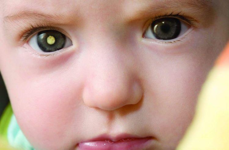 <p><strong>Herhangi bir Retinoblastom belirtisinden şüphelenildiği zaman mutlaka bir göz dibi muayanesi yapılmalıdır.</strong></p>