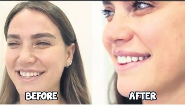 <p><span style="color:#800000"><em><strong>Dişlerindeki problemleri ve &ouml;n dişlerindeki şekil bozukluklarını gidermek i&ccedil;in diş hekimine başvurduğunu belirten oyuncu, "Dişlerimde problemler var onları hallettik. Bir de diş estetiği yaptırdım" </strong></em></span><span style="color:#000000"><em><strong>dedi.</strong></em></span></p>
