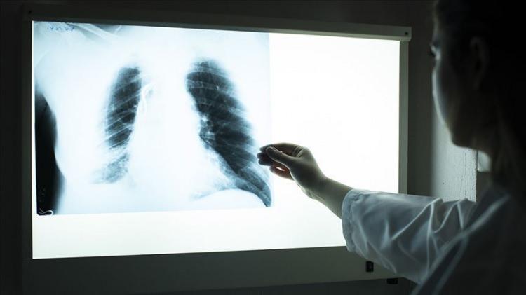 <p>Bu çalışma dünyanın en saygın kanser dergilerinden biri olan "Journal of Thoracic Oncology"de yayımlandı.</p>
