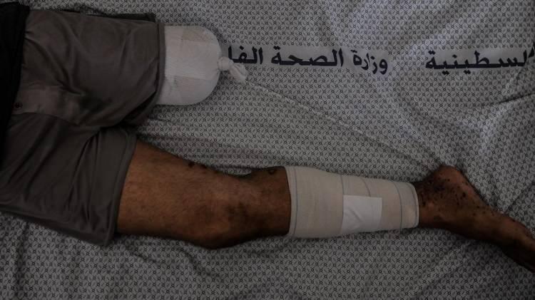 <p>İsrail'in Gazze'ye yönelik saldırılarında binlerce kişi hayatını kaybederken, uzuvlarını kaybeden yüzlerce insan bulunuyor.</p>