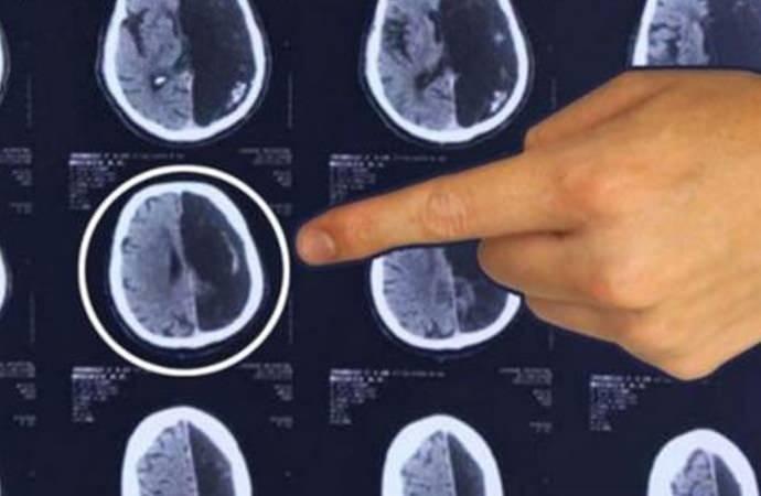 <p><span style="color:#000000"><strong>&Ouml;rneğin; Kaliforniya Teknoloji Enstit&uuml;s&uuml;'nde yapılan bir &ccedil;alışmada, beyninin yarısı olmayan 6 kişinin MRI (manyetik rezonans g&ouml;r&uuml;nt&uuml;leme) sonu&ccedil;ları incelenerek, sağlıklı insanların MRI sonu&ccedil;larıyla karşılaştırıldı. Yapılan incelemenin sonucunda ise yarım beyinle yaşamlarına devam eden bu 6 kişinin beyin aktiviteleri ile sağlıklı insanların beyin fonksiyonları arasında b&uuml;y&uuml;k &ouml;l&ccedil;&uuml;de benzerlik olduğu ortaya konuldu.</strong></span></p>
