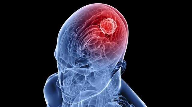 <p><span style="color:#000000"><strong>Beyinde oluşan k&uuml;&ccedil;&uuml;k hasarlar ve farklılıklar bile insan hayatını ciddi bir şekilde etkilerken beyninin b&uuml;y&uuml;k bir b&ouml;l&uuml;m&uuml;n&uuml; yitiren insanlar hakkında bug&uuml;ne dek bilim d&uuml;nyasında pek &ccedil;ok &ccedil;alışma y&uuml;r&uuml;t&uuml;ld&uuml;.&nbsp;</strong></span></p>
