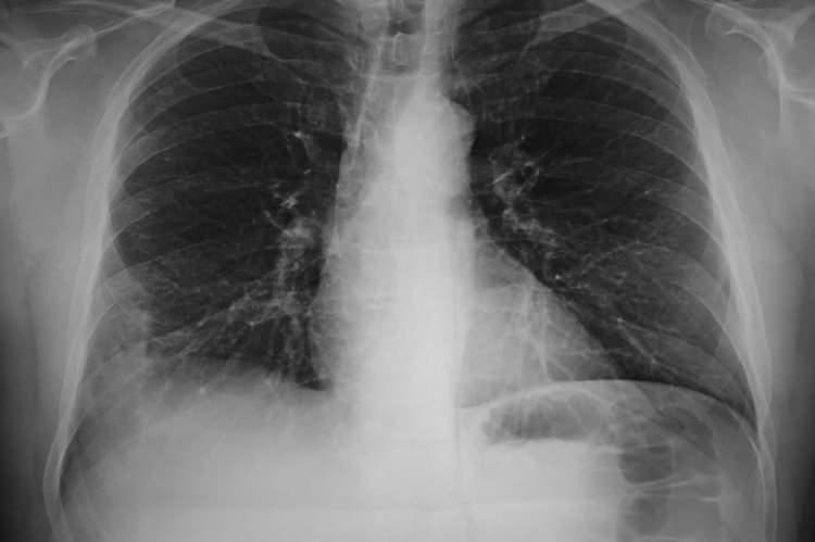 <p>RSV, adenovir&uuml;sler, enterovir&uuml;sler, rinovir&uuml;sler ve koronavir&uuml;sler dahil olmak &uuml;zere 200'den fazla vir&uuml;s solunum yolu enfeksiyonuna neden olabilir. Daha &ouml;nce benzer enfeksiyonlarla karşılaşılmamış gen&ccedil;lerde belirtiler daha ciddi olabilir. Spesifik bağışıklığın yeni bir patojene karşı hazırlık yapması yaklaşık bir hafta s&uuml;rer.</p>
