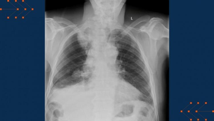 <p>Yapay zeka, 1,5 milyondan fazla hastadan alınan 2,8 milyon geçmiş göğüs röntgeni üzerinde eğitildi ve röntgenleri 37 olası durum için tarayabiliyor.</p>
