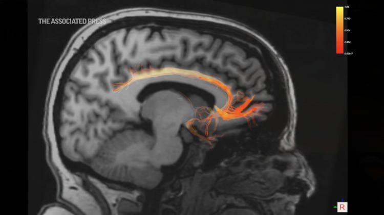 <p>Birçok ilacın yanı sıra elektroşok tedavisini de denediğini ve hiçbir şekilde kalıcı iyileşme kaydedilemediğini belirten Hollenbeck, bir doktorun tavsiyesiyle DBS'yi denemeye karar verdiğini söyledi.</p>
