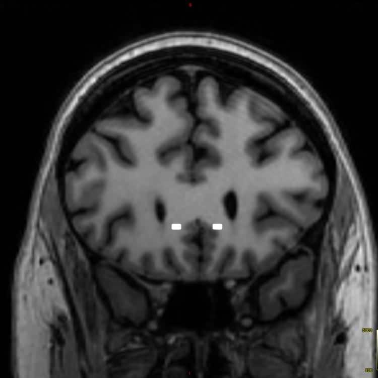 <p>New York'taki Mount Sinai Center for Neuromodulation adlı araştırma merkezi, DBS tedavisinin TDD üzerindeki etkilerini gözlemlemek için çalışmalar yürütüyor. </p>
