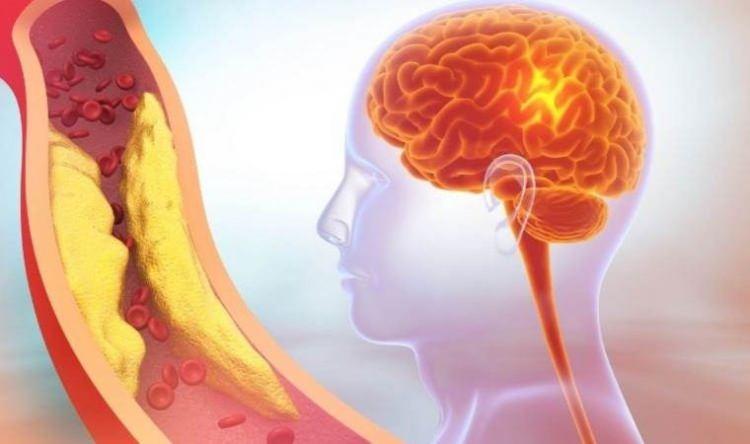 <p>Sağlıklı yaşayan, genetik risklerini iyi yöneten sağlığını dikkatle izleyen ve gerekli tedbirleri zamanında alan, beslenmesine, uykusuna, egzersizine dikkat eden, sağlık problemlerinin çözümüne özen gösteren kişilerde şahdamarları kolay kolay sertleşmez, plak yapmaz ve tıkanmaz. Şahdamarlarını tıkayan temel nedenleri önem sıralarına göre alttaki sorunun yanıtında bulabilirsiniz.</p>