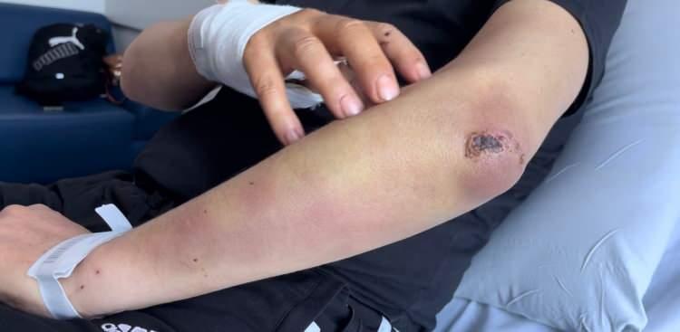 <p> </p>
<p> </p>
<p>Dehşet anları anlatan baba Karagözoğlu, “Arkadaşım iftara davet etmişti. Bende 10 yaşındaki oğlumla onlara gitmeden pide alalım dedim. O sırada caddenin karşı tarafında sürü halinde köpekler vardı. Bir anda oğlumun üzerine koşunca oğlumu ittim. Köpekler bana saldırmaya başladı. Çenem kırıldı, kulağım ve elim parçalandı. Şimdi ameliyat olacağım. Bir iki ay boyunca beslenemeyeceğim. Benim 2 çocuğum var ya bana bir şey olsaydı. Bunun hesabını kim verecekti? Ben yetkililerden bu konuya el atmasını istiyorum” diye konuştu.</p>