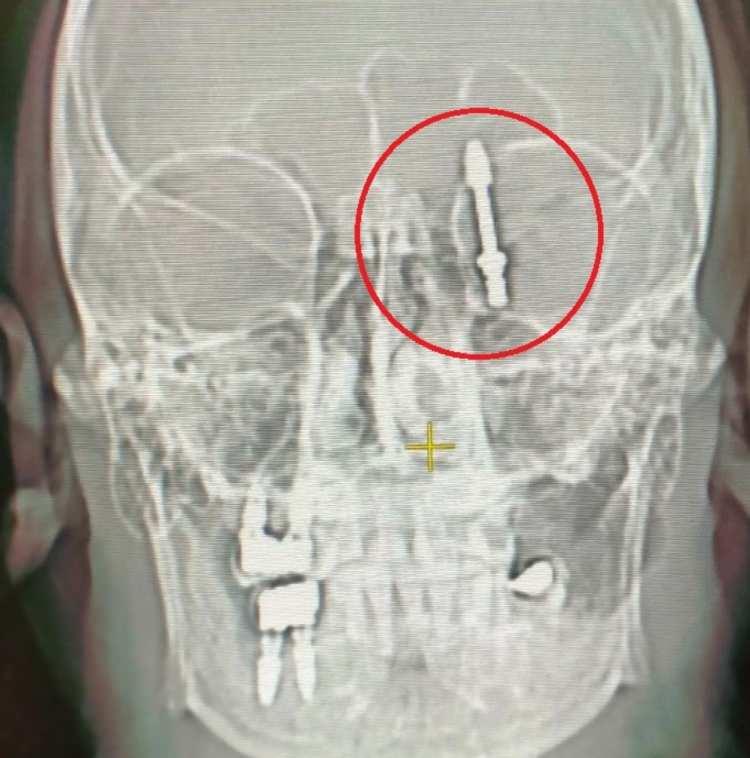 <p>İddiaya göre, implantı çeneye yerleştirmek isteyen doktorun yanlış müdahalesi sonrası vida, Yılmaz'ın çene kemiğini delip kafatasına saplandı. </p>
