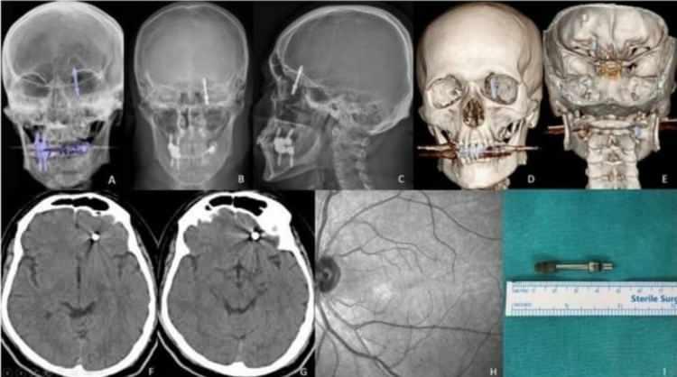 <p>Saatlerce süren operasyon sonrası hayata tekrar dönen Yılmaz, günlerce taburcu olmayı bekledi. Sağlığına dönen Yılmaz, kendisine yanlış müdahale yapan diş hekimini aradığında ise ikinci bir şoku yaşadı.</p>
