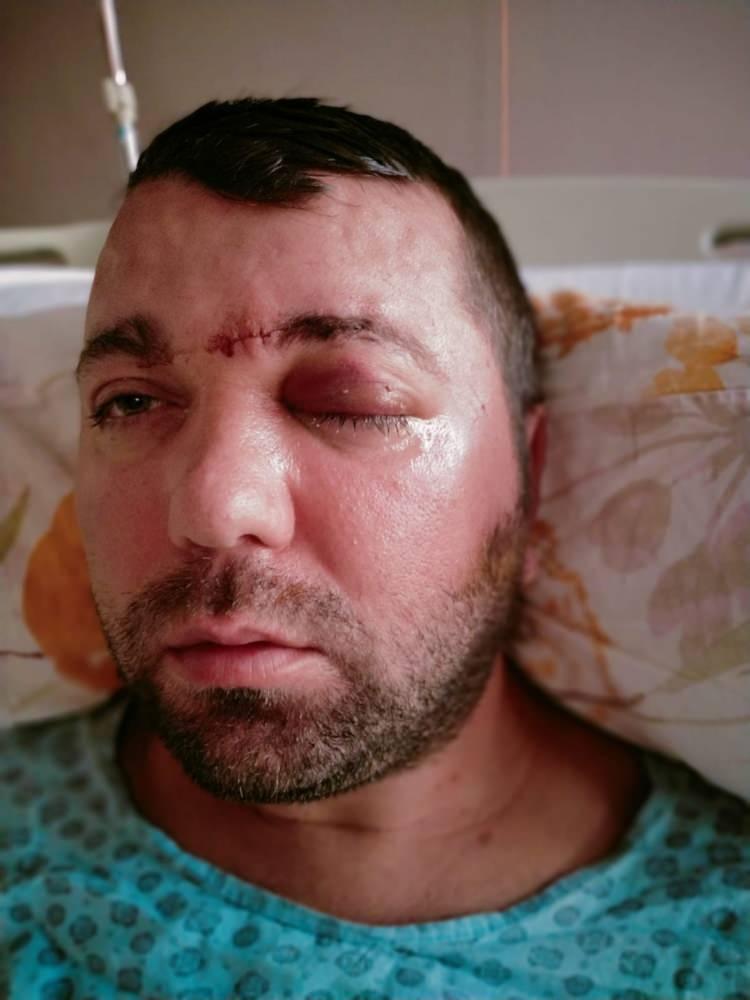 <div>"Aynı g&uuml;n implant yaptı"</div>

<div>Kendisini uyarmasına rağmen dinlemediğini ifade eden Yılmaz, "Daha sonra dişlerimi &ccedil;ekip, aynı g&uuml;n implant uygulaması yaparken, işlemde kullandığı cihazın bozuk olduğunu sekreterine s&ouml;yledi. Bu kez de işlemi eliyle yapmaya başladı. Vidayı yerleştirmeye &ccedil;alışırken, aşırı y&uuml;klendiğini fark ettim. Bunu kendisine s&ouml;yledim, kemik sesi geldiğini ifade ettim. Fakat bu kez de bana bunun normal olduğunu s&ouml;yledi. Ama vidayı zorlarken, vida &ccedil;ene kemiğimi delip g&ouml;z duvarının arkasından beyin omurilik sıvısının olduğu b&ouml;lgeye saplandı. Ben acıdan dolayı bağırınca r&ouml;ntgen &ccedil;ektirdi" dedi.</div>
