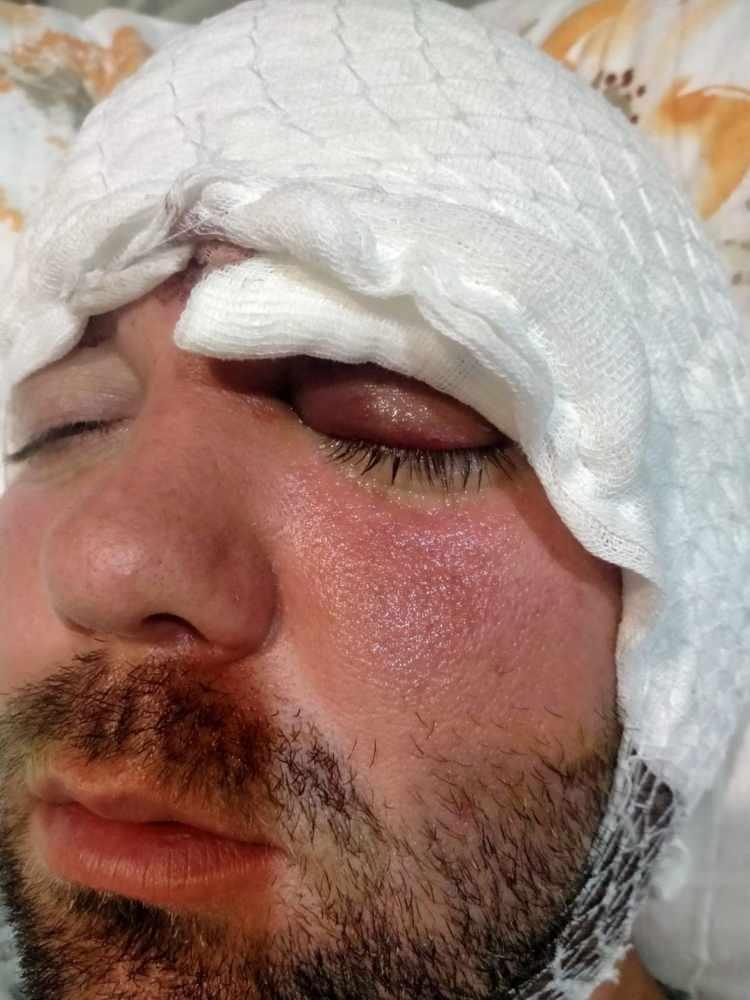 <div>"Hastaneye bırakıp gitti"</div>

<div>Doktorun kendisini hastaneye bırakıp ka&ccedil;tığını iddia eden Yılmaz, "Durumun ciddiyetini anlayınca beni Uludağ &Uuml;niversitesi Hastanesinin Acil b&ouml;l&uuml;m&uuml;ne getirip gitti. Burada yapılan inceleme sonrası vidanın beyin omurilik sıvısının olduğu yere saplandığı g&ouml;r&uuml;ld&uuml;. Daha sonra uzman hekimler bir araya gelip, ameliyat i&ccedil;in karar aldılar. Ameliyat &ouml;ncesi bana hayatımı kaybedebileceğimi s&ouml;ylediler. Ben artık &ccedil;ocuklarımla helalleşip vedalaştım. &Ccedil;ok ş&uuml;k&uuml;r ameliyattan sağ salim &ccedil;ıktım. Bu s&uuml;re&ccedil;lerde diş hekimi hi&ccedil; bir zaman yanımda olup mağduriyetimi gidermedi, hatta &ouml;dediğim &uuml;creti dahi geri iade etmedi. &Uuml;st&uuml;ne &uuml;stelik benimle dalga ge&ccedil;er gibi konuştu. Bunların hepsi belgeli. Ben yetkililerden devlet b&uuml;y&uuml;klerimizden bu konuyla ilgilenilmesini istiyorum. Benim iki &ccedil;ocuğum var. Bana bir şey olsaydı bunların hesabını kim verecekti ? Şimdi dava s&uuml;recine girdik. Kendisinden şikayet&ccedil;i oldum" diye konuştu.</div>

<div>&Ouml;te yandan, kendisine y&ouml;nelik su&ccedil;lamalara daire konuşan doktor A.D., "Tıbbi bir komplikasyondan dolayı b&ouml;yle bir olay ger&ccedil;ekleşti. Kendisi benimle ilgili bu konuda yasal yollara başvuru yaptı, fakat benim b&ouml;yle bir tavrım olmadı" ifadelerini kullandı.</div>

<div>&Ouml;te yandan Yılmaz'ı sağlığına kavuşturan doktorların başarılı ameliyatı, Amerika'da literat&uuml;re girip dergilere konu oldu.</div>

