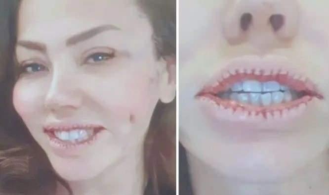 <p>Lara, estetikle dudaklarını küçülttürmüştü. Gözyaşları içinde pişman olduğunu söyleyen Lara,<strong><em> "Ne olur bana dua edin, dudağımla pipet bile tutamıyorum. Lütfen hiçbir yerinize bir şey yaptırmayın. Dudağınız kötüyse bile kalsın"</em></strong> ifadelerini kullanmıştı.</p>
<p> </p>