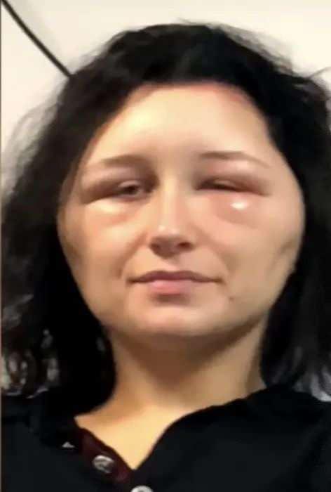 <p><span style="color:#000000"><strong>Sabah uyandığı gördüğü manzara karşısında korku dolu anlar yaşayan Estelle, yüzünün adeta ampul şekli aldığını gördü. Öyle ki Estelle'in baş çevresi 56 cm'den 63 cm'ye çıkmıştı ve bu durum tipik bir alerjik reaksiyondan çok uzaktı.</strong></span></p>