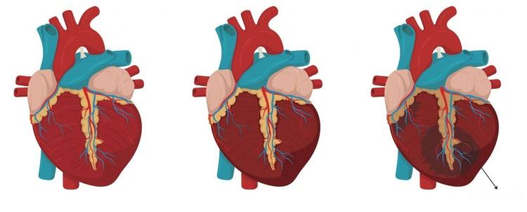 <p>Ayaz'ın hastalığı ve tedavi süreciyle ilgili AA muhabirine konuşan Doç. Dr. Serdar Demir, sendrom nedeniyle hastaların kalbinde elektriksel üretimde bir bozukluk meydana geldiğini belirtti.</p>

<p> </p>
