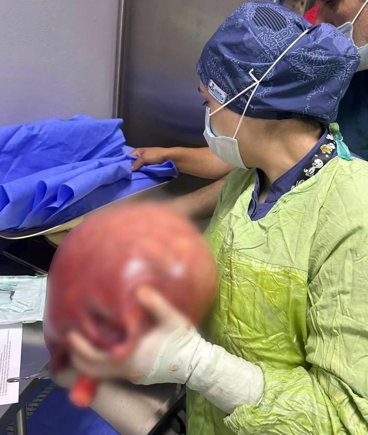 <p>"Gerekli müdahaleyi yapıp ameliyatı tamamladık. Hastamızın ilginç bir şekilde hiç bir şikayeti olmamış, sadece kilo aldığını zannetmiş ve bu durumu geciktirmiş."</p>
<p> </p>