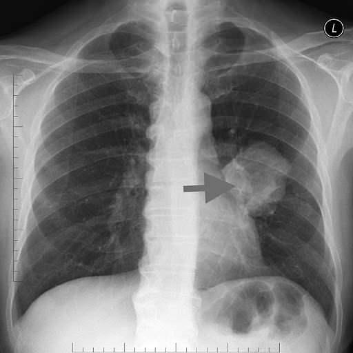 <p>Doktorlar, kanser olabileceği düşündükleri Xu'ya tam teşhis koyabilmek için akciğer dokusundan parça alarak testler yaptı. Yapılan testler sonucu, doktorların kötü huylu tümör sandığı kitlenin acı biber parçası olduğu anlaşıldı.</p>