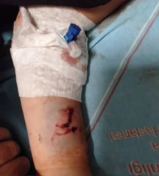 <p>Kanlar i&ccedil;inde kalan k&uuml;&ccedil;&uuml;k Yağız, &ccedil;ağrılan ambulansla Antalya Eğitim ve Araştırma Hastanesi'ne kaldırıldı. Yağız'ın başı, kulağı ve koluna 50'ye yakın dikiş atıldı. Taburcu edilen Yağız &Ccedil;etin'in babası Serhat &Ccedil;etin, saldırgan k&ouml;peğin sahibi hakkında polise şikayet&ccedil;i oldu. Aile aradan bunca yıl ge&ccedil;mesine rağmen oğlunun hala yatakta sı&ccedil;radığını kaydetti.</p>

<p>&nbsp;</p>
