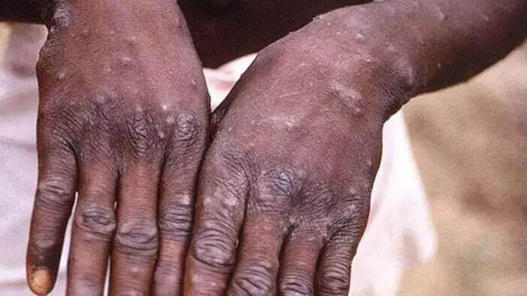 <p>Dünya Sağlık Örgütü (DSÖ), "maymun çiçeği hastalığı (Monkeypox)" ismini, 2022'de ırkçılık ve ayrımcılık kaygısıyla "mpox" olarak değiştirdi.</p>
