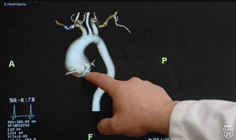 <p><strong>Rich'in kalbinden çıkan ana arterde 2,8 inç çapında (yaklaşık 7 cm) şişmiş bir çıkıntı vardı.</strong></p>

<p> </p>
