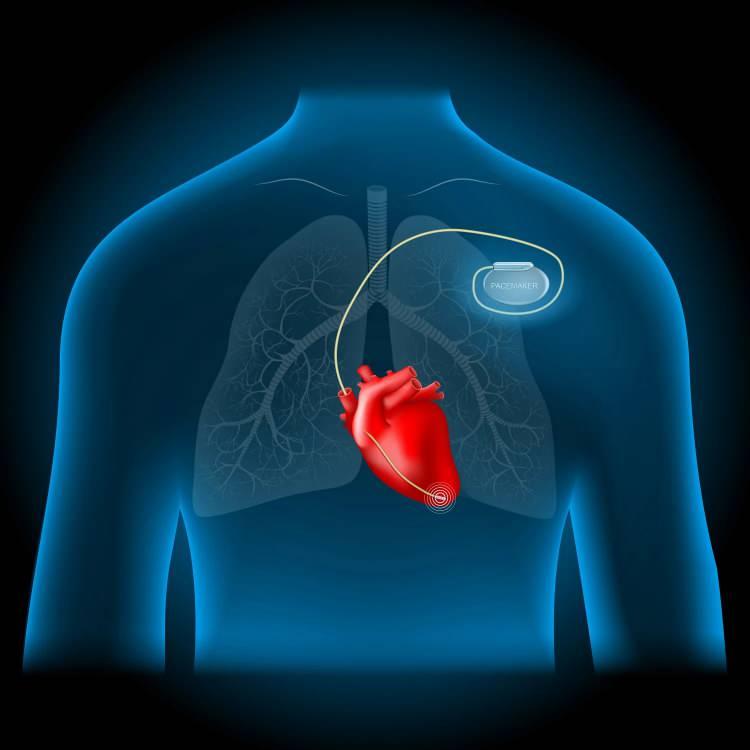 <p>Bir diğer saldırıya uğrayabilecek medikal cihaz ise uzaktan kontrollü kalp pilleridir (pacemaker). Barnaby Jack 2012 yılında kalp pili üzerinden nasıl suikast yapılacağını göstererk anlatmıştır. Bu durum ayrıca Homeland dizisinde de konu edinmiştir.</p>

<p> </p>

<p>ABD’de doktorun uyguladığı ilaçların takibi için kullanılan sistemdeki teknik hataları tespit eden Charles Cullen isimli hemşire sistemdeki açığı kullanarak 2006 yılında yakalanana kadar 16 yılda en az 40 hastayı ölümüne neden olduğunu kabul etmiştir.</p>
