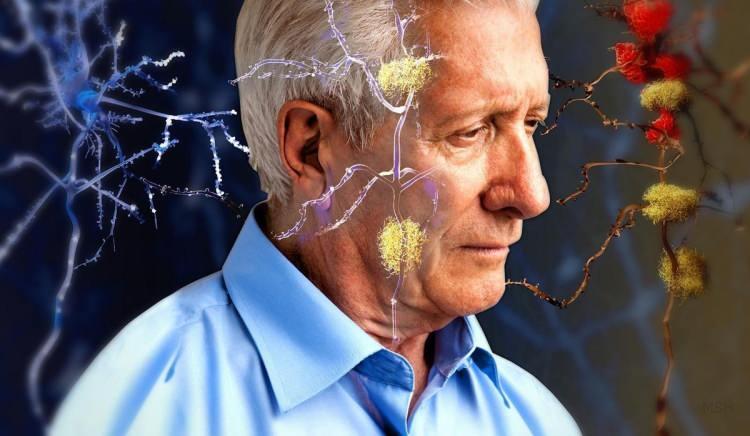 <p>Alzheimer hastalığının temel biyolojik göstergeleri arasında yer alan Amiloid-beta ve tau proteinleri, uyku ile Alzheimer hastalığının moleküler belirteçleri arasındaki bağlantıyı gösterdi.</p>
