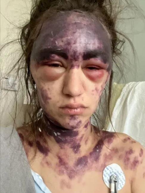 <p>Hastanede yapılan işlemi paylaştığı videolar ile aktaran Alexis Lorenze ise çocukluğundan beri böyle bir durumun olmadığını iddia ederek ağrı ve şişliklerinin devam etmesi nedeniyle daha ileri tedavi için farklı bir hastaneye nakil olmayı düşünüyor. </p>

